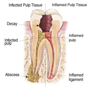 Dental Infections: Causes, Symptoms, Prevention & Diagnosis